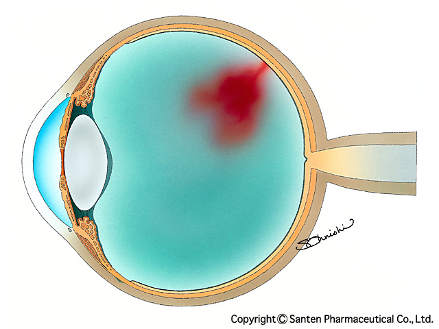 眼底出血とは