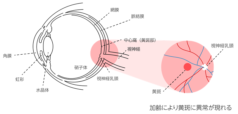 加齢黄斑変性は目の生活習慣病