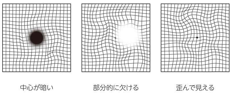 加齢黄斑変性の初期症状