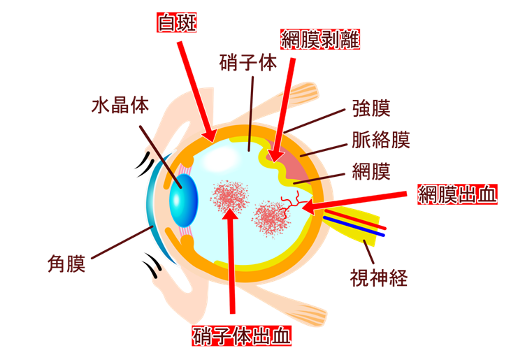 糖尿病性網膜症初期～末期の症状