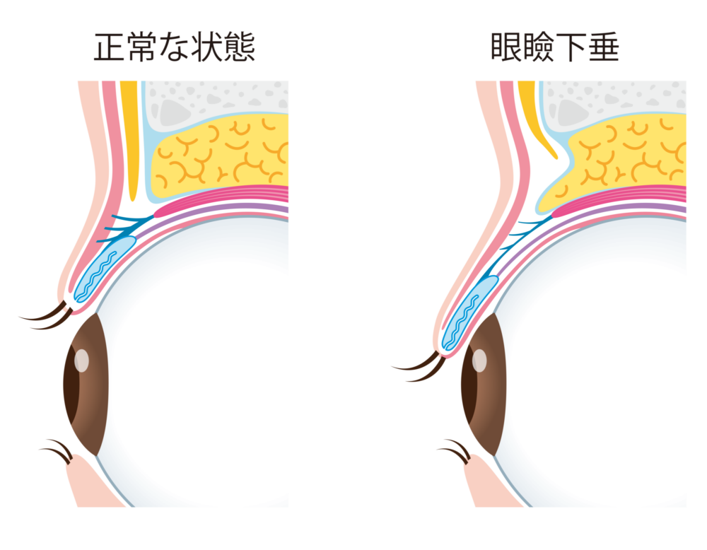 上まぶたが垂れ下がる眼瞼下垂