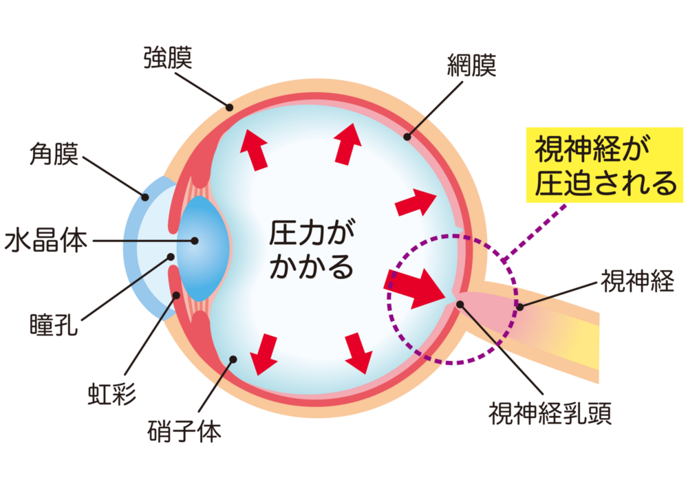 緑内障とは？