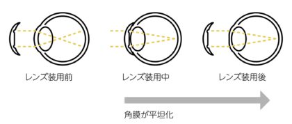 睡眠中に視力補正「オルソケラトロジー」