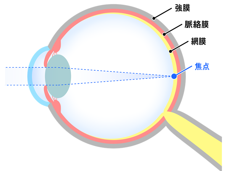 屈折異常（近視・遠視・乱視）について