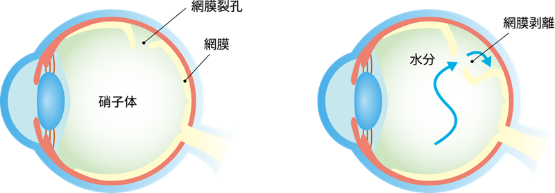 20代でも発症する「網膜剥離」