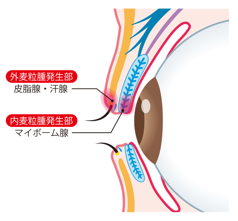 瞼に細菌が感染する「麦粒腫」